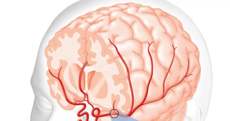 Brain 167. Синусопатия головного мозга. ВББ В медицине. Цереброваскулярная недостаточность.