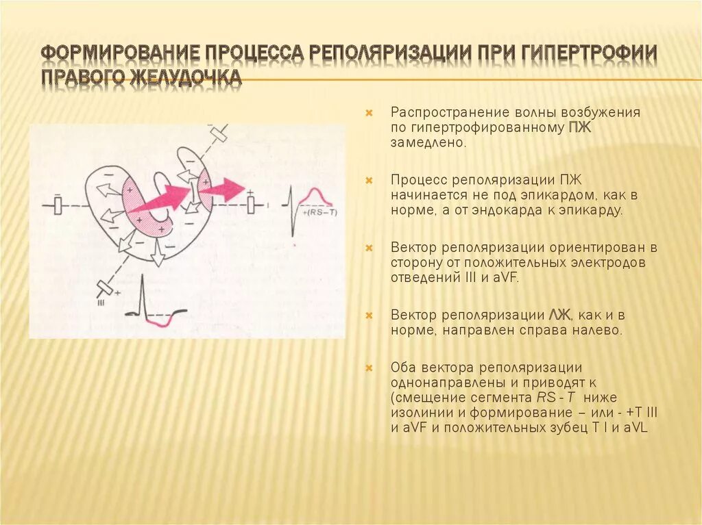 Умеренные изменения реполяризации. Реполяризация миокарда желудочков ЭКГ. Изменения процессов реполяризации миокарда желудочков. Нарушены процессы реполяризации что это. Нарушение процессов реполяризации левого желудочка.