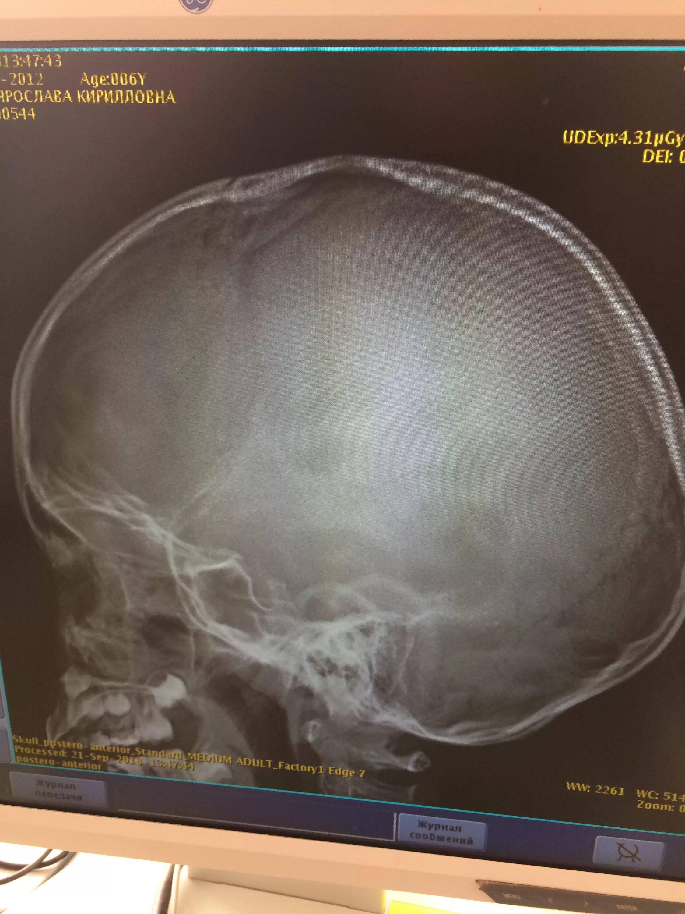 Детский череп рентген. Снимок черепа ребенка рентгеновский. Детский череп рентген снимок. Снимок рентгена черепа младенца.