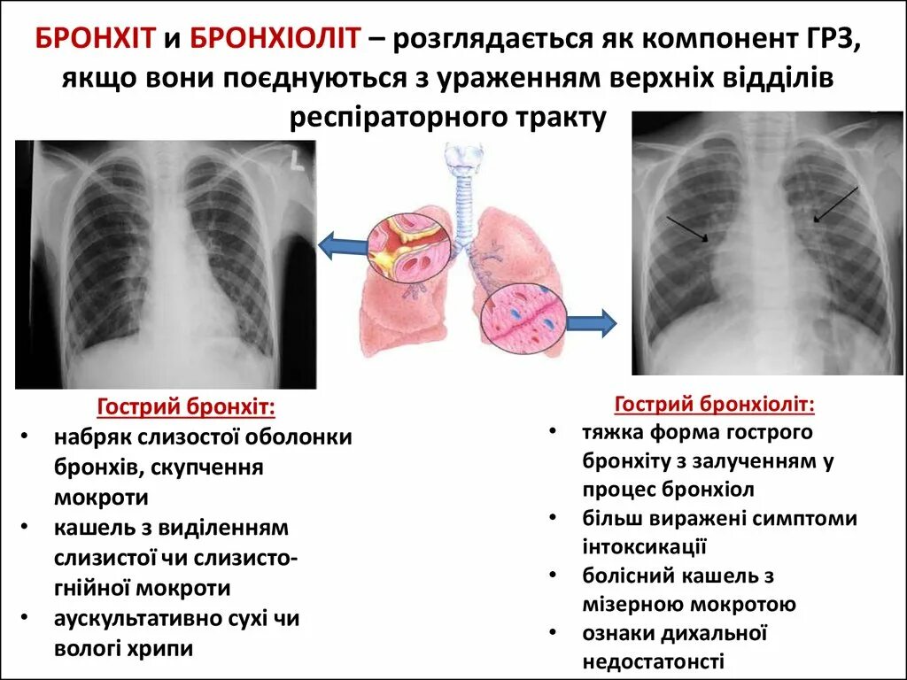 Сухие хрипы без кашля и температуры. Хрипы в легких при бронхите. хрипы при бронхите у ребенка. хрипы в лёгких при бронхите. хрипы в лёгких у ребенка.