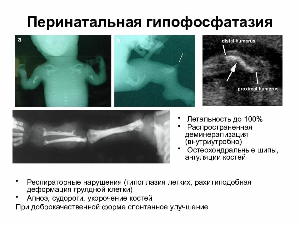 Укорочение трубчатых