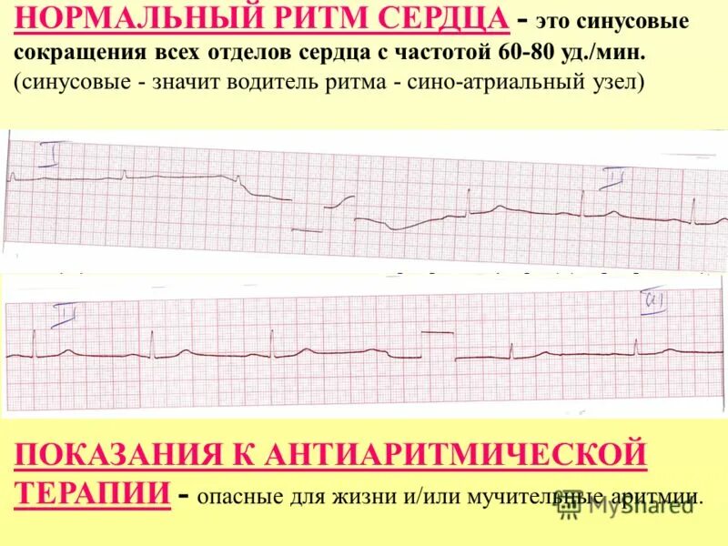Норма пульса тахикардия брадикардия. Ритм синусовый. При синусовой тахикардии :. Нормальное сердцебиение кардиограмма. Ритм сердца это.
