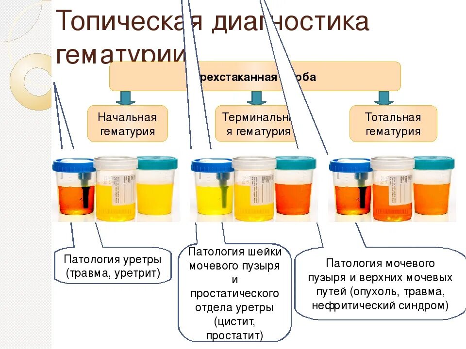 Розовая моча у мужчин. Гематурия трехстаканная проба. Расшифровка анализа мочи 3 стаканная проба. Трехстаканная проба мочи при гематурии. Двухстаканная проба при гематурии.