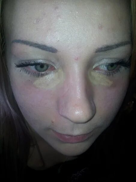 Лазерное осветление кожи. Блефаропластика со2 кандела. Лазерное удаление синяков. Лазерное удаление синяков. Периорбитальная гиперпигментация.