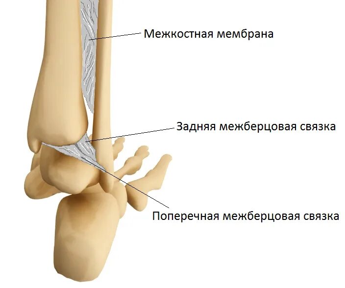 Дистальный разрыв. Дистальный синдесмоз большеберцовой кости. Разрыв дистального синдесмоза. Связки межберцового синдесмоза сустава. Перелом лодыжки синдесмоз.