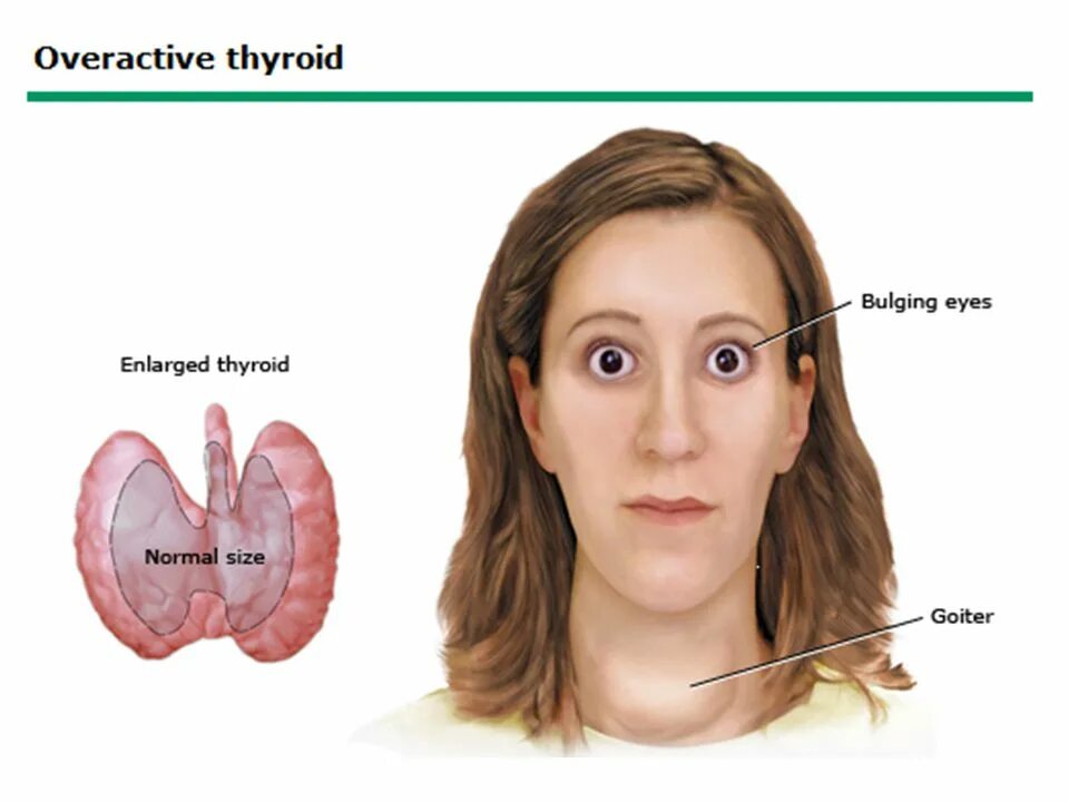 диффузно-узловой нетоксический зоб клиника. зоб 1 степени щитовидной железы что это. назовите степени увеличения щитовидной железы?. степени увеличения щитовидной железы. зоб 1 степени щитовидной железы что это.