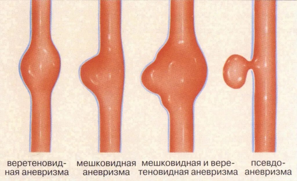 Мешотчатая аневризма внутренней. Мешотчатая аневризма сосудов головного. веретеновидная аневризма. мешковидная аневризма брюшной аорты. аневризма и псевдоаневризма.