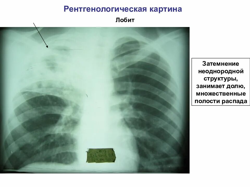 Лобить. Инфильтративный туберкулез рентгенография. Инфильтративный туберкулез нижней доли рентген. Инфильтративный туберкулез верхней доли рентген.