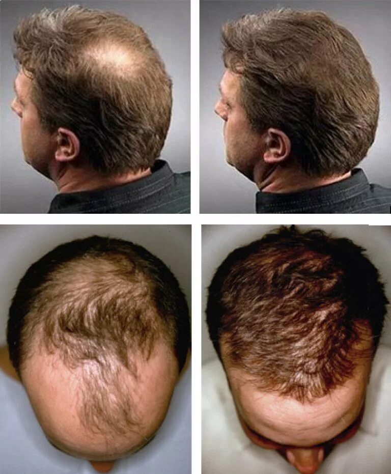 Инъекции головы. Андрогенная алопеция миноксидил. Дарсонваль алопеция до после. Мезотерапия волос до и после.