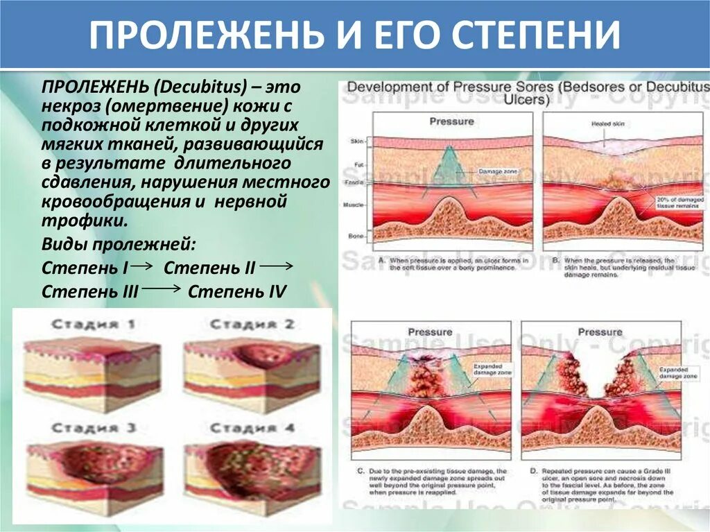 Отслойка эпидермиса пролежни. Профилактика пролежней 1 стадии. Эффективное лечение пролежня