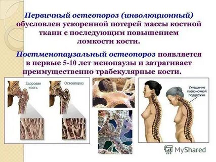 Причины остеопороза