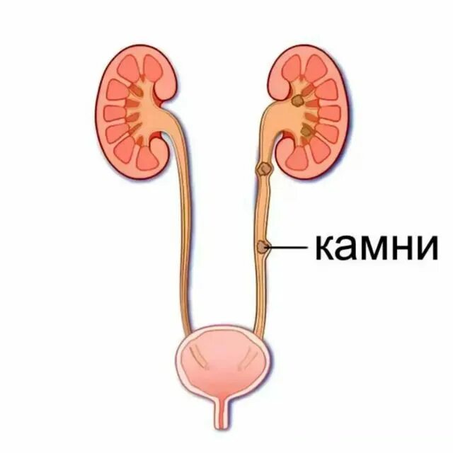 строение почки и мочеточника устье. мочеточник строение сужения. катетер стент мочеточника. камень в устье мочеточника 7 мм. стент в мочеточнике рентген.
