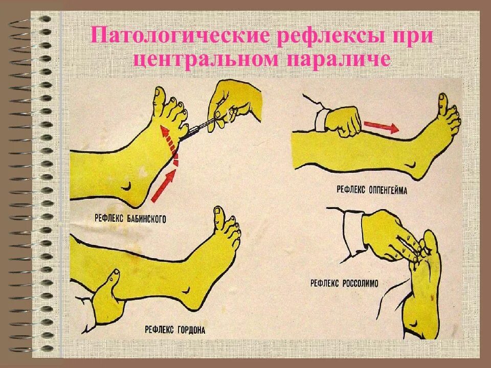 Патологические стопные сгибательные рефлексы. Пирамидные симптомы Бабинского Оппенгейма Россолимо Гордона. Подошвенный рефлекс Бабинского. Сгибательные патологические рефлексы нижних конечностей.