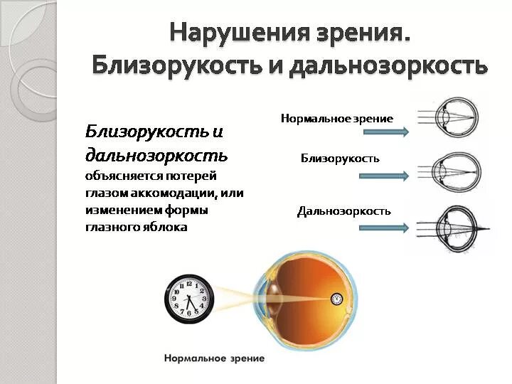 Минус и плюс в зрении. Причины нарушения зрения близорукость дальнозоркость. Нарушения зрения подростка: близорукость и дальнозоркость. -1,5 Зрение близорукость и дальнозоркость. Таблица нарушение зрения близорукость дальнозоркость.