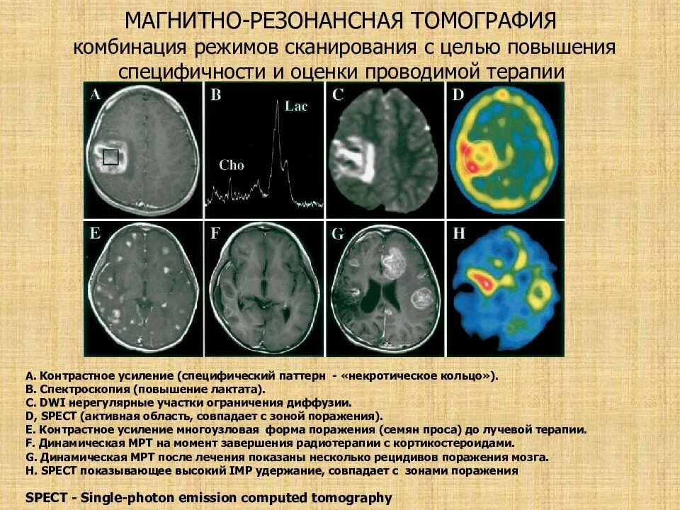 Диагностические критерии глиомы головного мозга. Объемное образование головного мозга диагноз. Локализация опухолей головного мозга. Диагностические критерии опухоли головного мозга.