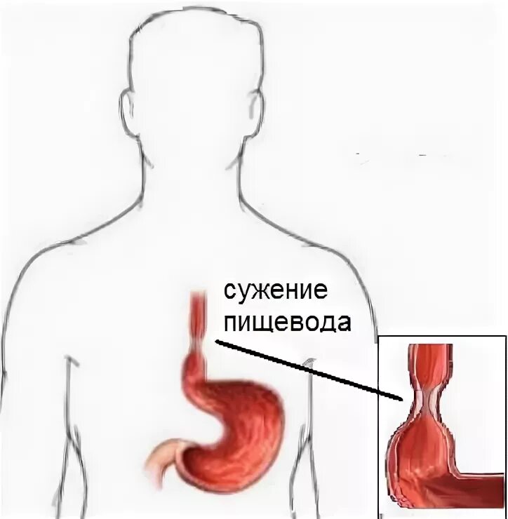 Плохой пищевод. Рубцовые стриктуры пищевода. Рубцовый стеноз пищевода.