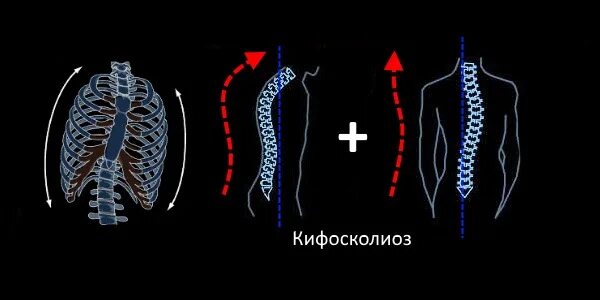 Кифосколиоз мкб. Кифосколиоз грудного отдела позвоночника 2 степени. кифосколиоз грудной клетки. кифосколиоз грудного отдела 1 степени. кифосколиоз и деформация грудной клетки.