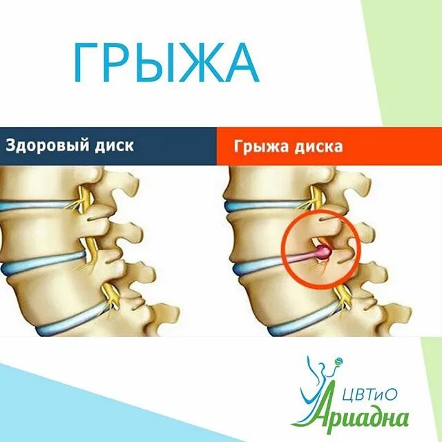Грыжа симптомы и лечение. Параэзофагеальная грыжа пищеводного отверстия. Ущемленная пупочная грыжа операция. Ущемленная пупочная грыжа операция. Ущемленная наружная грыжа живота классификация.