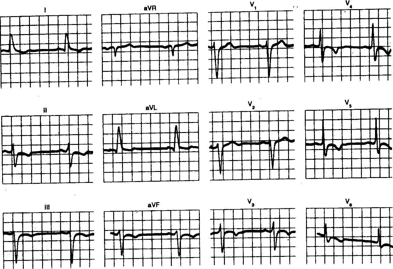 Неполная блокада передней. Блокада левого желудочка Гиса. Блокада левого желудочка пучка Гиса. Блокада левого желудочка сердца. Блокада левого желудочка на ЭКГ.