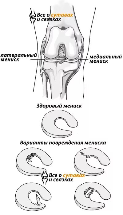 Поврежденный мениск коленного сустава