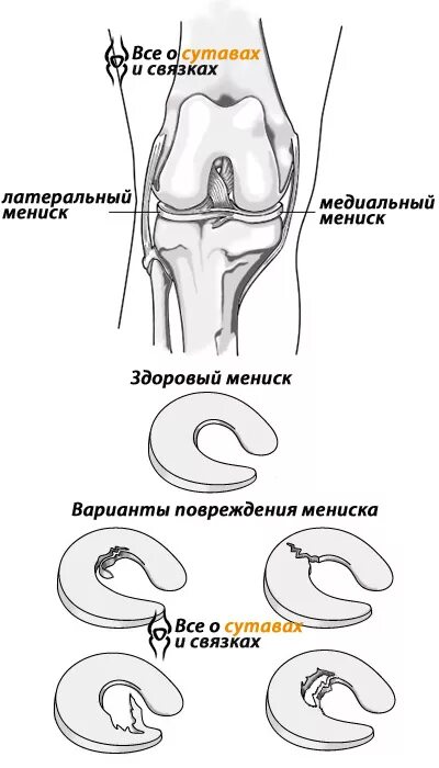 Повреждения мениска коленного сустава как лечить