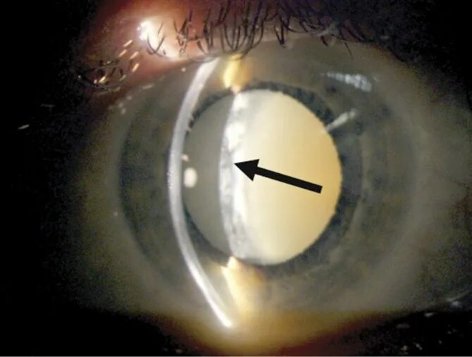 Биомикроскопия глаза хрусталик. Катаракта биомикроскопия. Биомикроскопия хрусталика норма. Ядерная катаракта биомикроскопия.