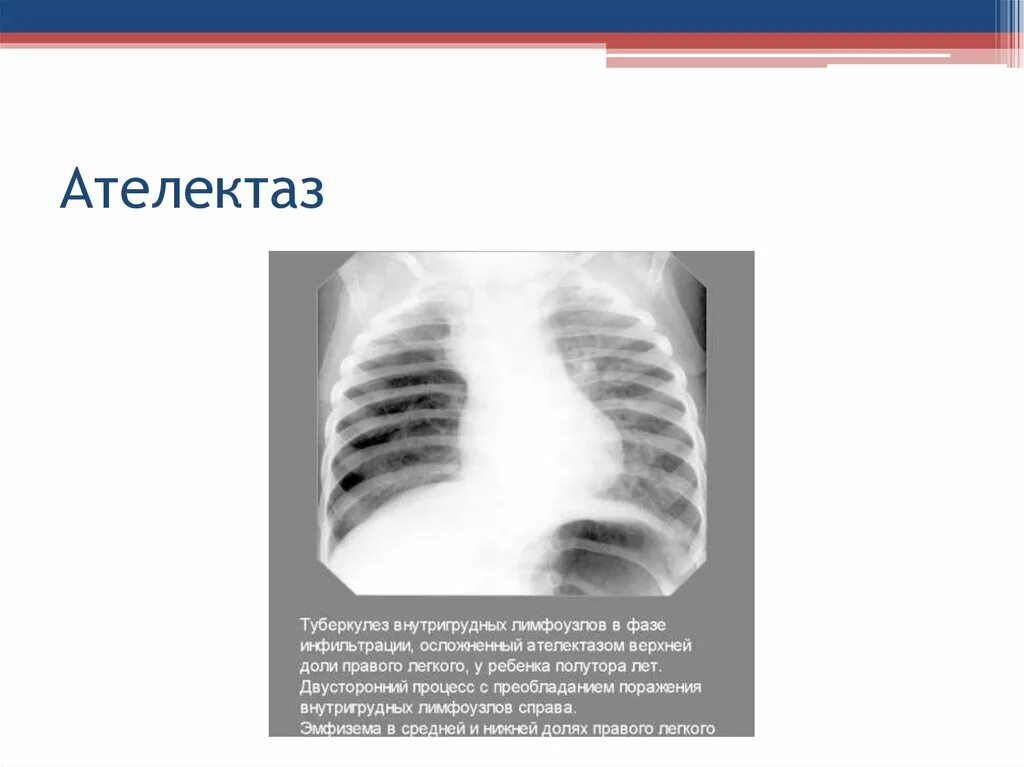 Аспирационный ателектаз легкого. Ателектаз на рентгене. Компрессионный ателектаз легкого. Дисковидный ателектаз. Ателектаз нижнего легкого