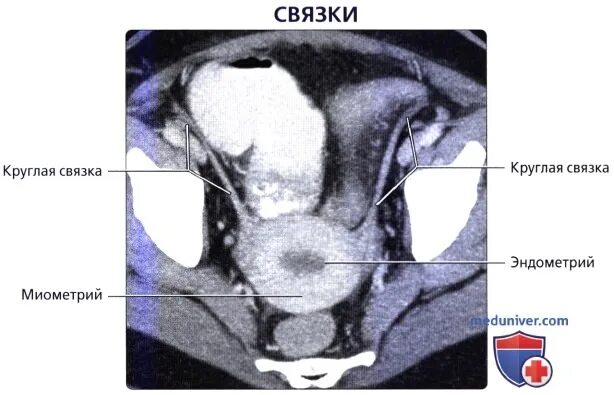 Круглая связка матки кт. Круглая связка матки мрт. Где находятся круглые связки