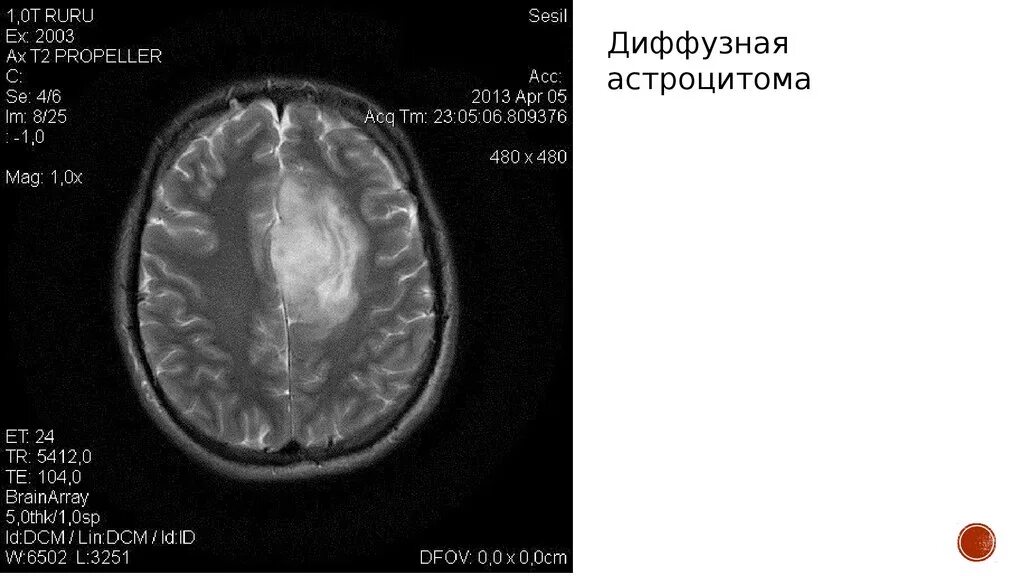 Астроцитома головного мозга. Кистозно-Солидное образование головного мозга. Диффузная астроцитома на кт головного мозга. Диффузная опухоль головного мозга. Диффузная астроцитома