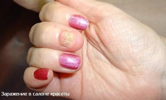 плесень под гелем