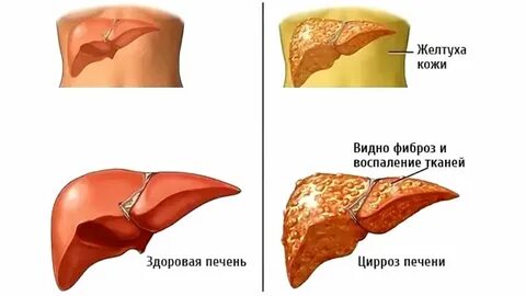 Жидкость в печени о чем говорит