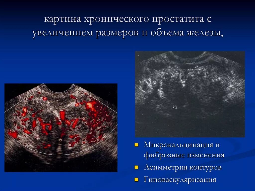 Хронический простатит предстательной железы. Хронический простатит. УЗИ картина хронического простатита. Хронический простатит на УЗИ. Уз картина хронического простатита.