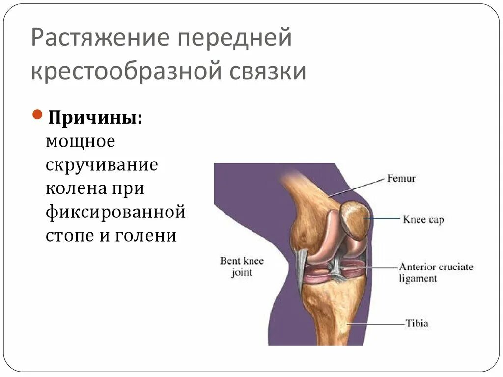 Разрыв связок коленного сустава презентация. Крестообразная связка колена. Разрыв крестообразной связки коленного сустава. Симптомы крестообразной связки коленного сустава