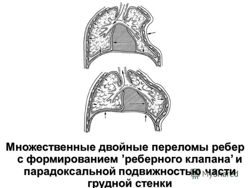 оскольчатый перелом ребер. окончатый перелом ребер. патофизиология ушиба. уровни повреждения патофизиология. двойные переломы ребер.