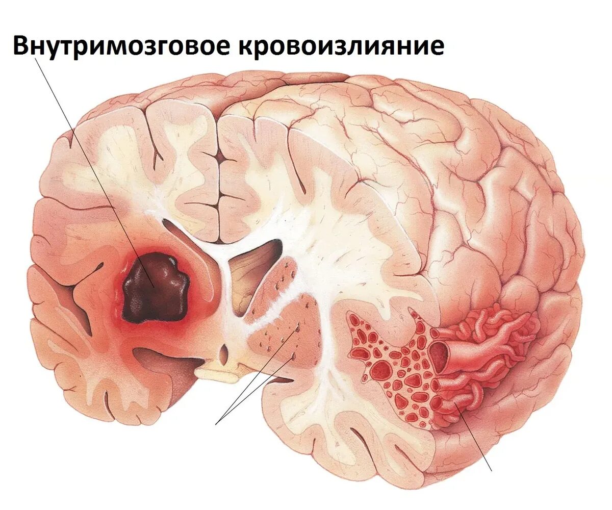 Субкортикальное внутримозговое кровоизлияние. Геморрагический инсульт внутримозговое кровоизлияние. Субарахноидальное субарахноидальное кровоизлияние. Субарахноидальное кровоизлияние в мозг макропрепарат. Травматическое кровоизлияние