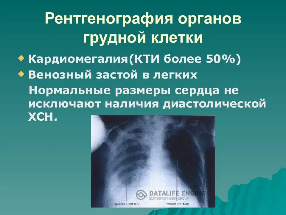 Рентгенография органов грудной клетки при ХСН. Рентгенография грудной клетки при ХСН. Рентгенография грудной клетки при застойной ХСН. Застойная сердечная недостаточность рентген. Застойные изменения в легких