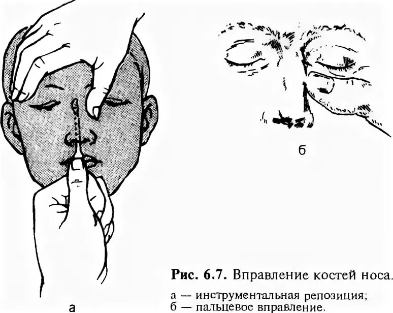 Можно вправить нос. Операция репозиция костей носа. Элеватор Волкова для репозиции костей носа. Закрытая репозиция костей носа. Пальцевая репозиция костей носа.