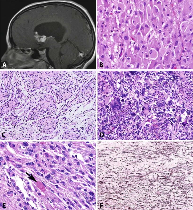 Пилоидная астроцитома. Фибриллярная астроцитома гистология. Пилоцитарная астроцитома гистология. Глиома головного мозга гистология.