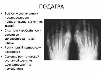 Рентгенологические признаки подагры