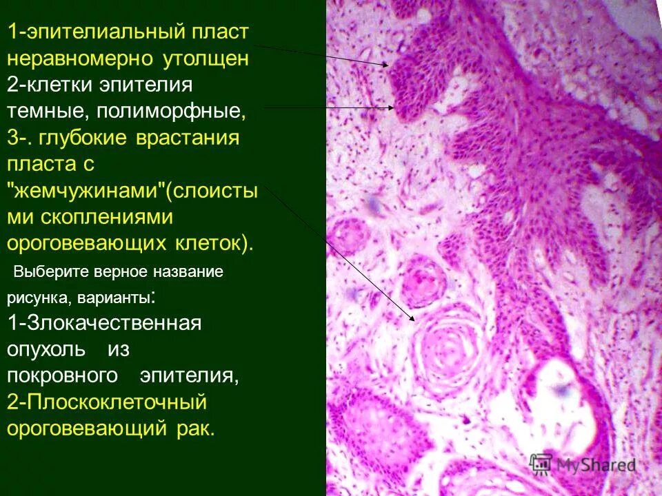 злокачественная опухоль эпителиальной ткани. цистаденокарцинома яичника гистология. перстневидноклеточный(слизистый)рак желудка. виды рака из покровного эпителия. виды рака из покровного эпителия.