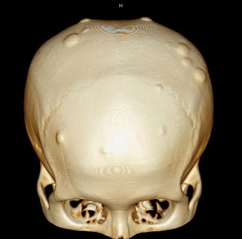 Костные шишки на черепе.