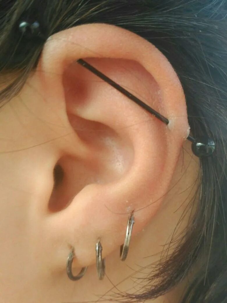 Келоидный рубец индастриал. Индастриал прокол келоиды. Индастриал после прокола. Угловой индастриал прокол. Прокол хряща хеликс штанга.