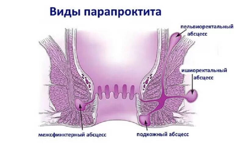 Хронический парапроктит ишиоректальный. Пельвиоректальный парапроктит осложнения. Ишиоректальный парапроктит операция. Острый парапроктит свищ.