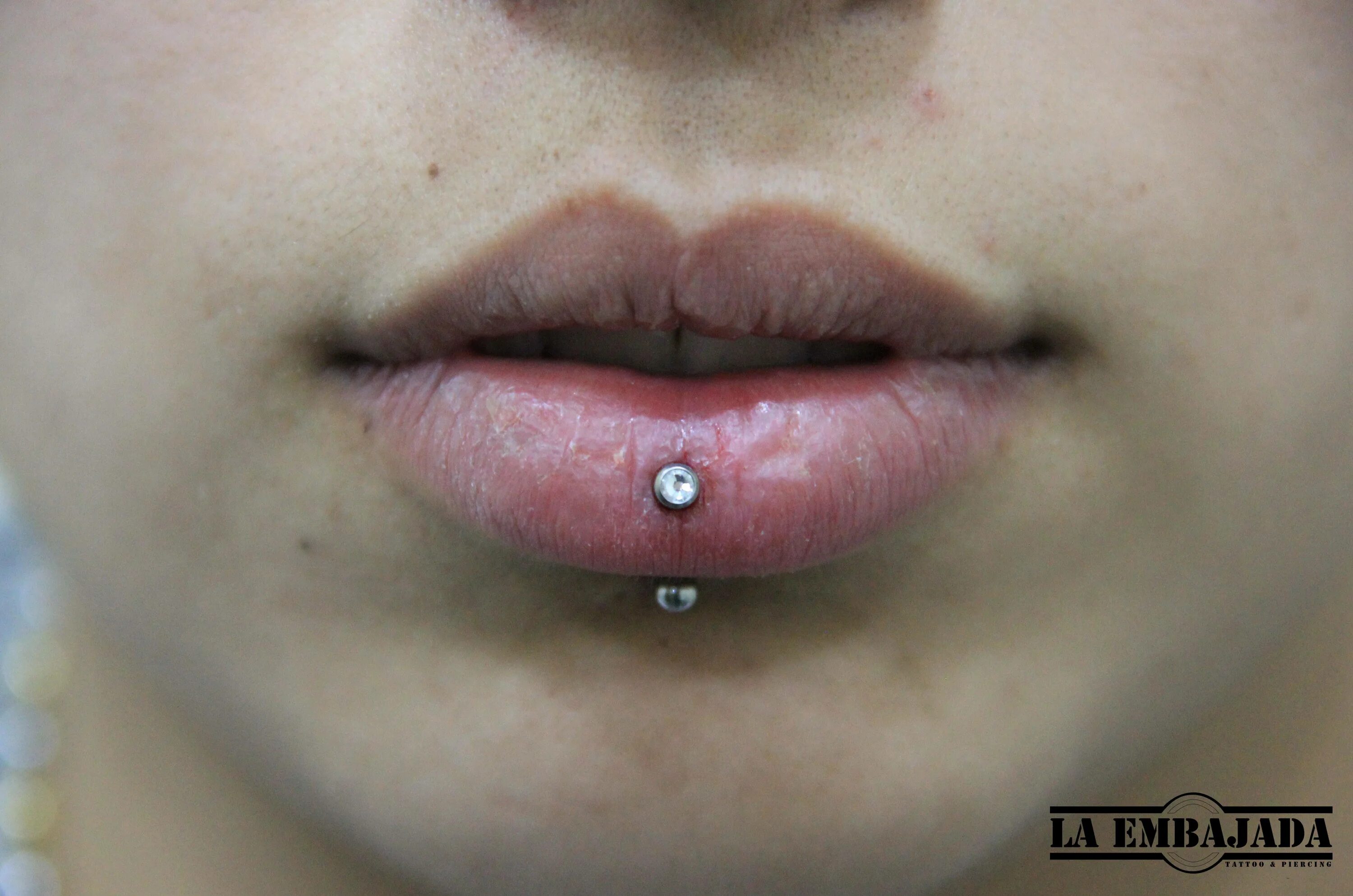 Вертикальный лабрет пирсинг. Губа после прокола. Вертикальный лабрет пирсинг нижней губы. Губа после прокола. Пирсинг губы вертикальный лабрет.