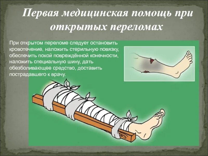 1 помощь при закрытых повреждениях. Оказание первой помощи при переломе ноги. Первая помощь припереломаз. ПМП при открытом переломе конечности. Наложение повязки при открытом переломе.