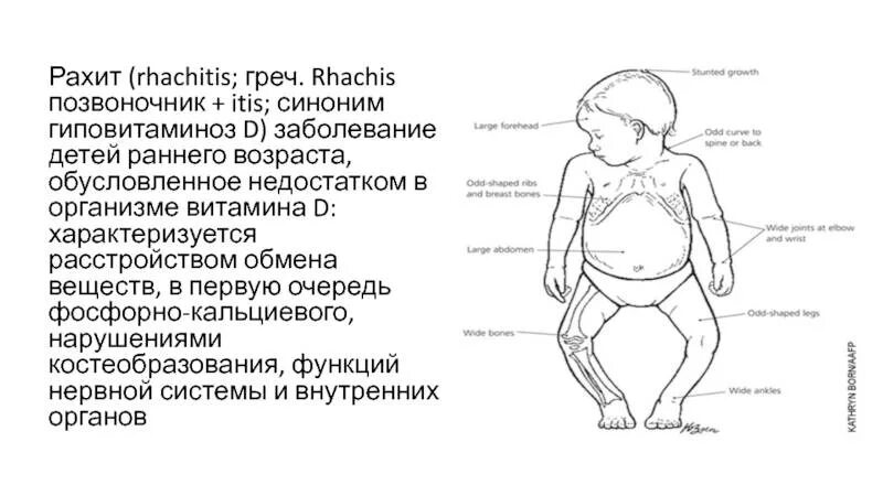 Схема клинические проявления рахита. Рахит витамин-д-зависимого типа. Витамин д зависимый рахит у детей. 1 признаки рахита