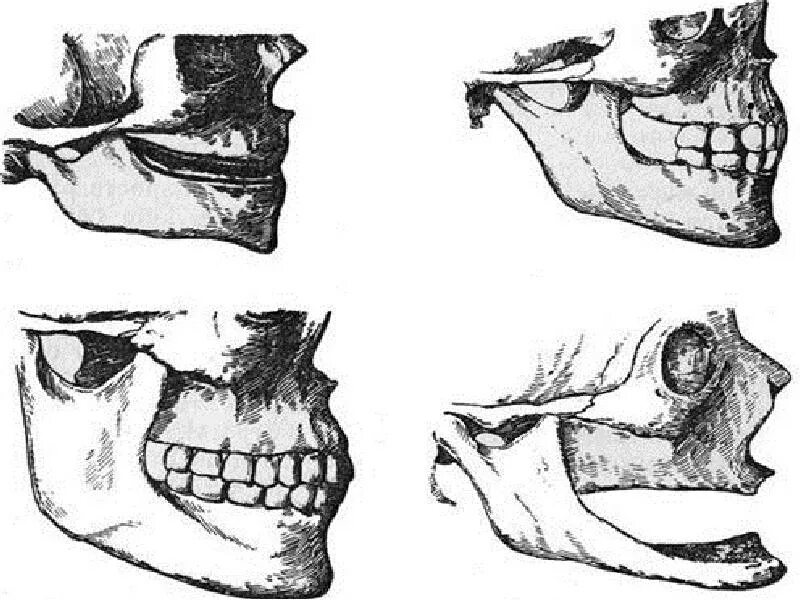 Возрастные изменения нижней челюсти. Возрастные изменения ВНЧС. Возрастные изменения височно нижнечелюстного сустава. Угол нижней челюсти анатомия.