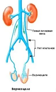 Варикоцеле у мужчин что это