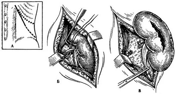 Люмботомия нефрэктомия. Радикальная нефрэктомия.