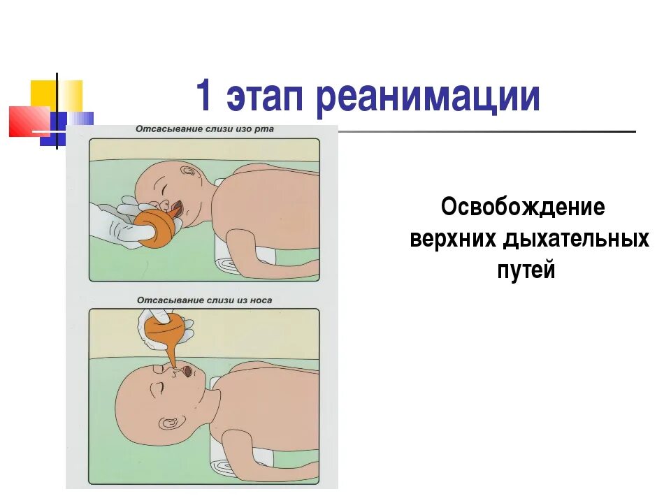 Алгоритм при асфиксии новорожденного. Асфиксия новорожденных реанимация этапы. этапы реанимации при асфиксии новорожденного. ивл при асфиксии новорожденного алгоритм. реанимация новорожденных при асфиксии 2 этап.